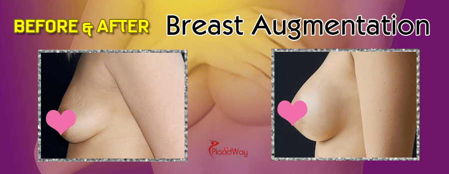 Breast Augmentation before after